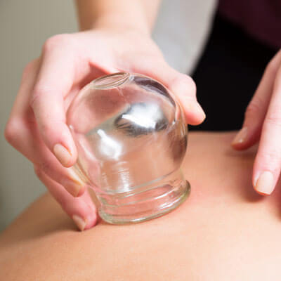 Cupping therapy applied to tight back muscles at Weston Creek Chiropractic Centre