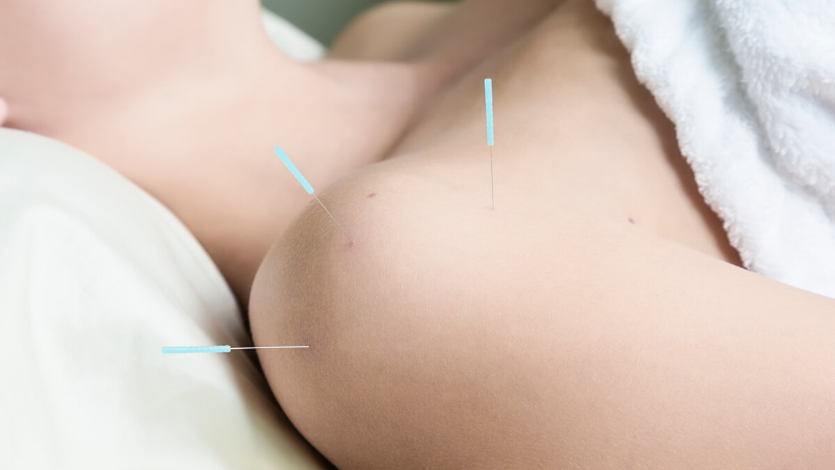 Dry needling of a tight shoulder by massage therapist Colleen Gould in Canberra